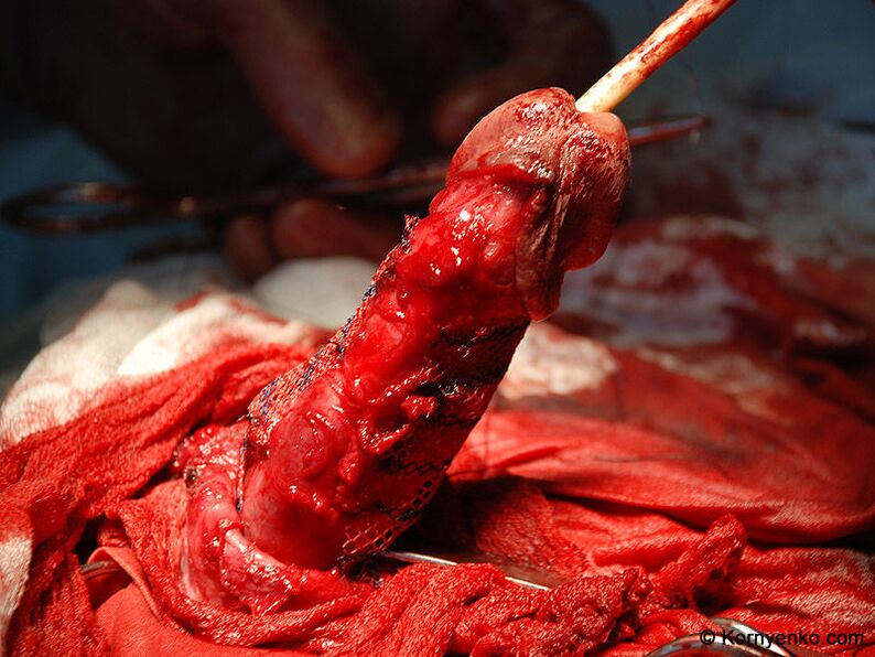 instalace kolagenové matrice pro zvětšení penisu