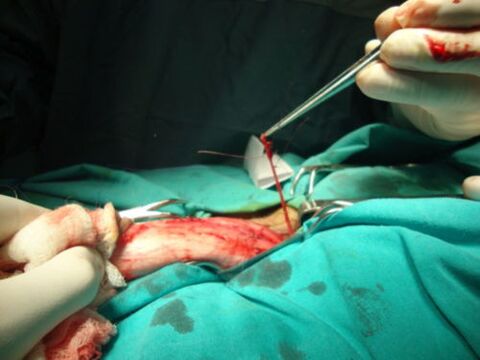 operace zvětšení penisu