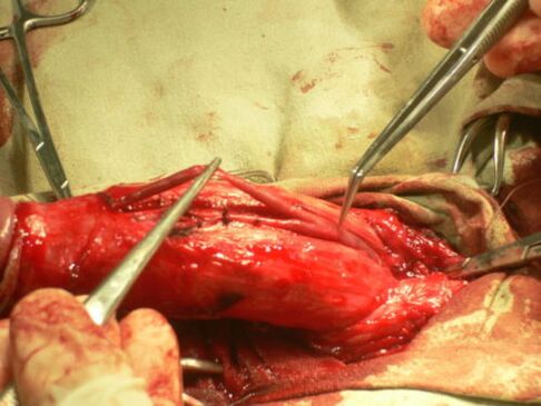 provádění operace zvětšení penisu