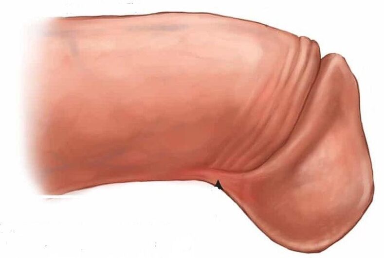 jak zvětšit žalud penisu